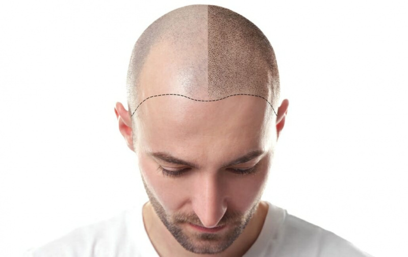 Mikropigmentace pokožky hlavy