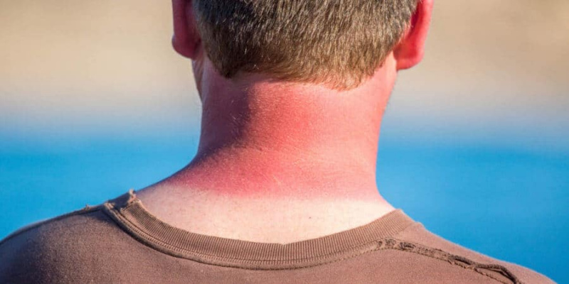 Mantenha a pele protegida dos raios UV